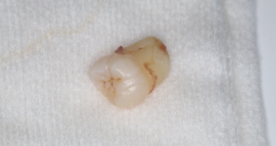 抜去歯の写真31